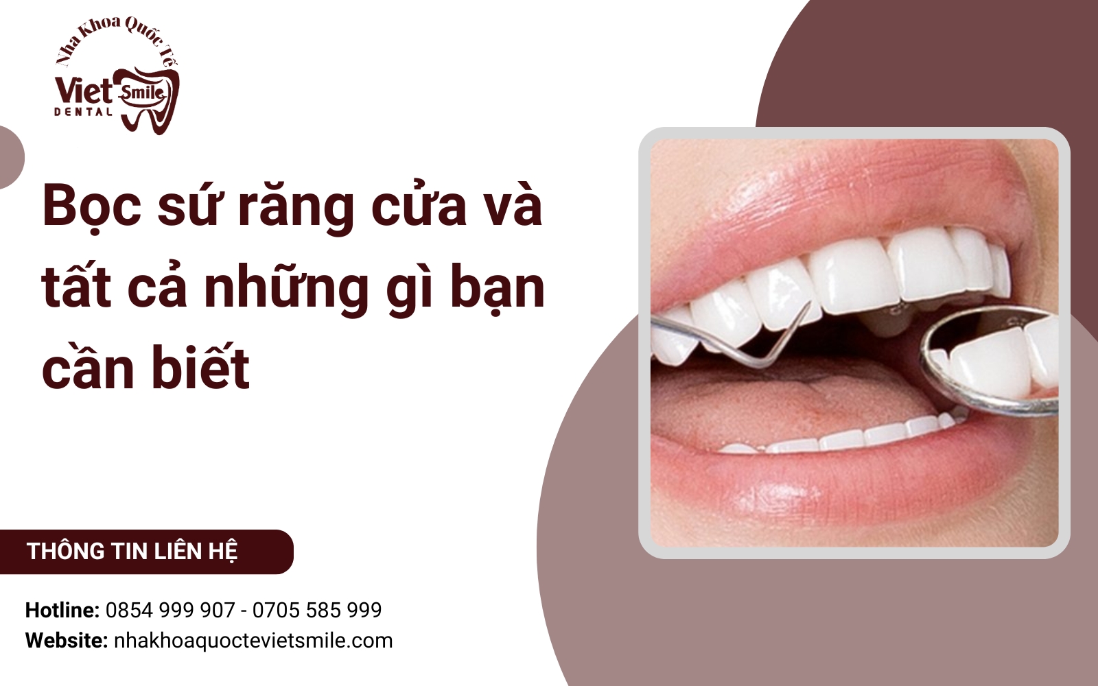 Bọc sứ răng cửa và tất cả những gì bạn cần biết