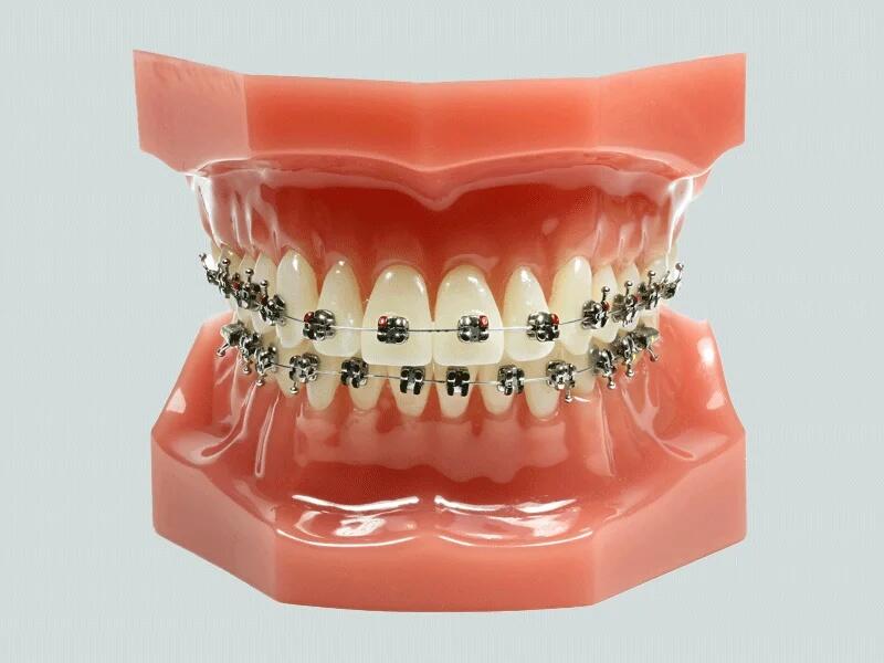 Mắc cài kim loại truyền thống