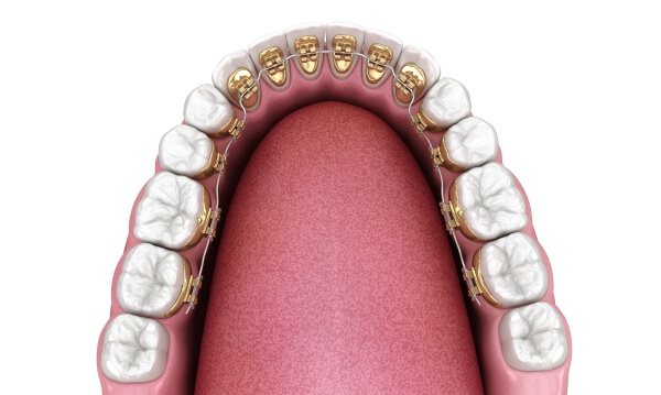 Mắc cài kim loại mặt trong (mắc cài mặt lưỡi)