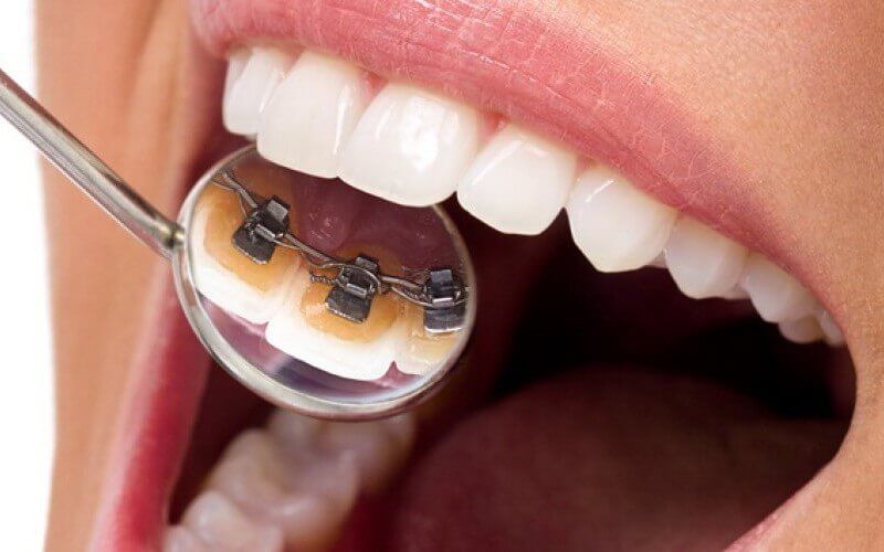 Niềng răng mắc cài mặt trong