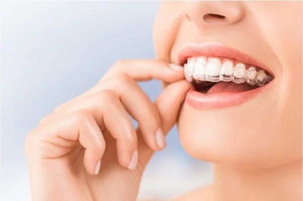 Niềng răng trong suốt Invisalign