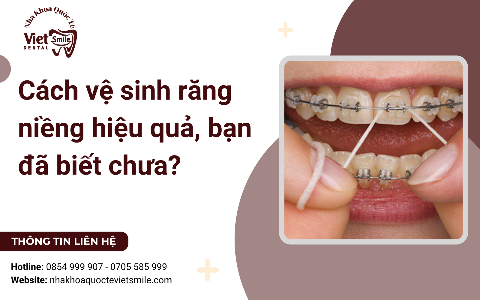 Cách vệ sinh răng niềng hiệu quả, bạn đã biết chưa?
