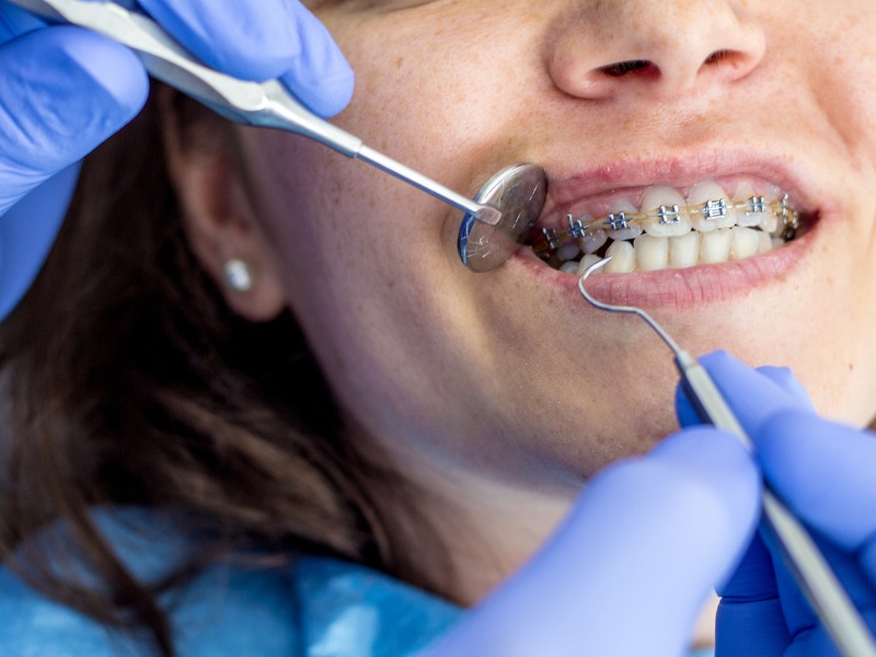 Cắm vít niềng răng có đau không?