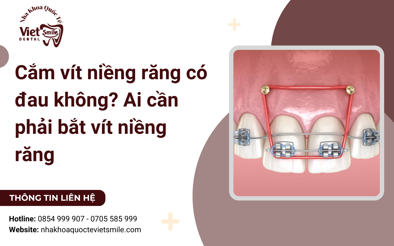 Cắm vít niềng răng có đau không? Ai cần phải bắt vít niềng răng
