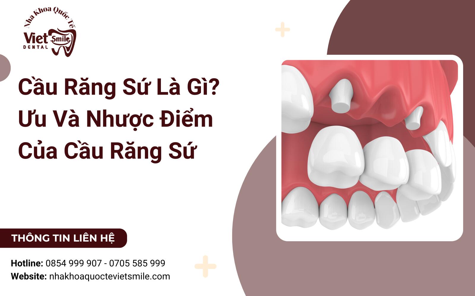 Cầu Răng Sứ Là Gì? Ưu Và Nhược Điểm Của Cầu Răng Sứ
