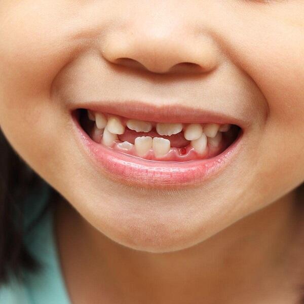 Tình trạng răng miệng của trẻ