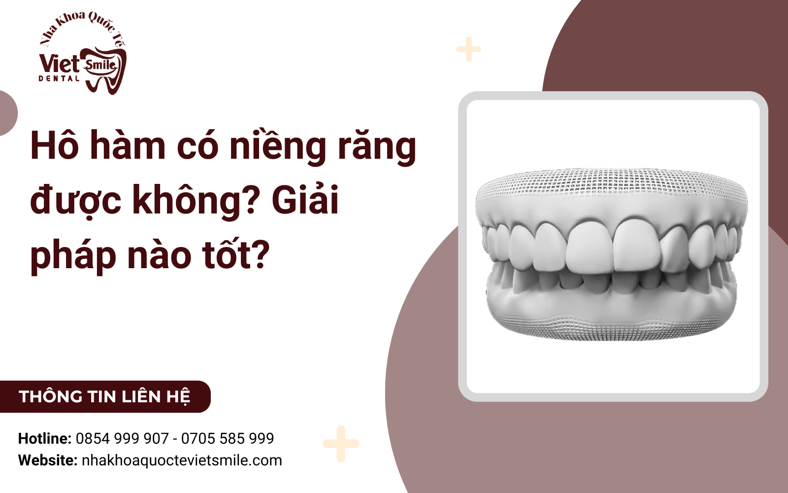 Hô hàm có niềng răng được không