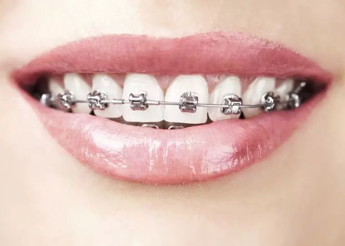 Niềng răng mắc cài tự động