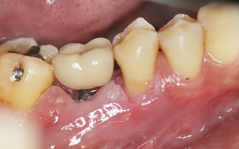 Răng Implant bị viêm là gì?