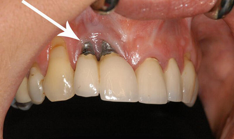 Những biểu hiện thường thấy ở răng implant bị viêm