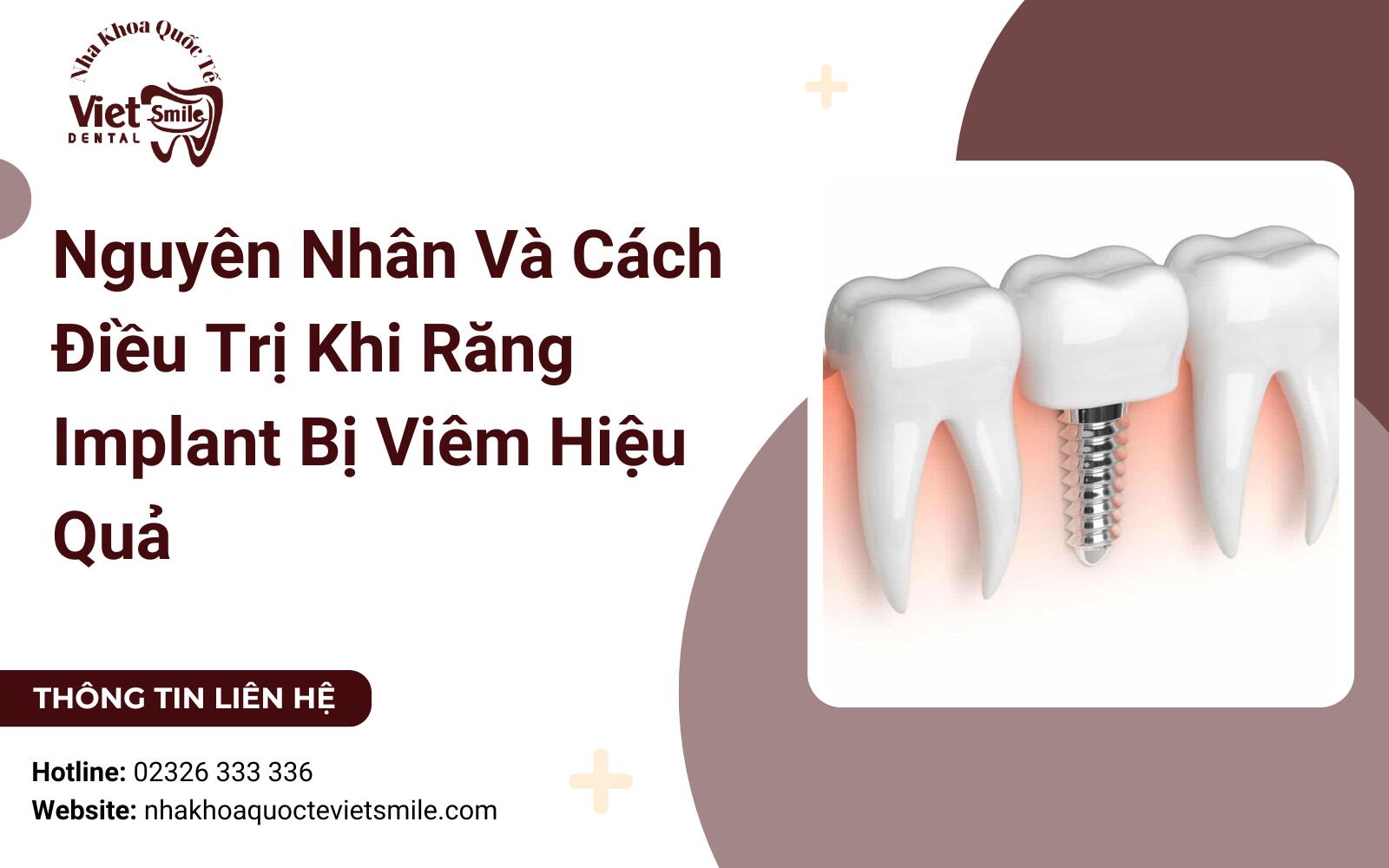 Nguyên Nhân Và Cách Điều Trị Khi Răng Implant Bị Viêm Hiệu Quả