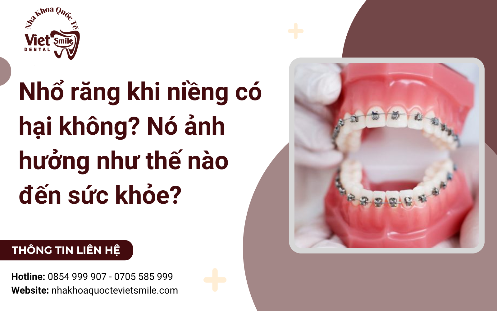 Nhổ răng khi niềng có hại không? Nó ảnh hưởng như thế nào đến sức khỏe?