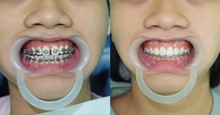 Những trường hợp nào nhất định phải nhổ răng để niềng?