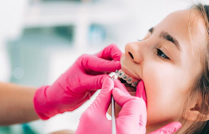 Phương pháp chỉnh nha cho trẻ