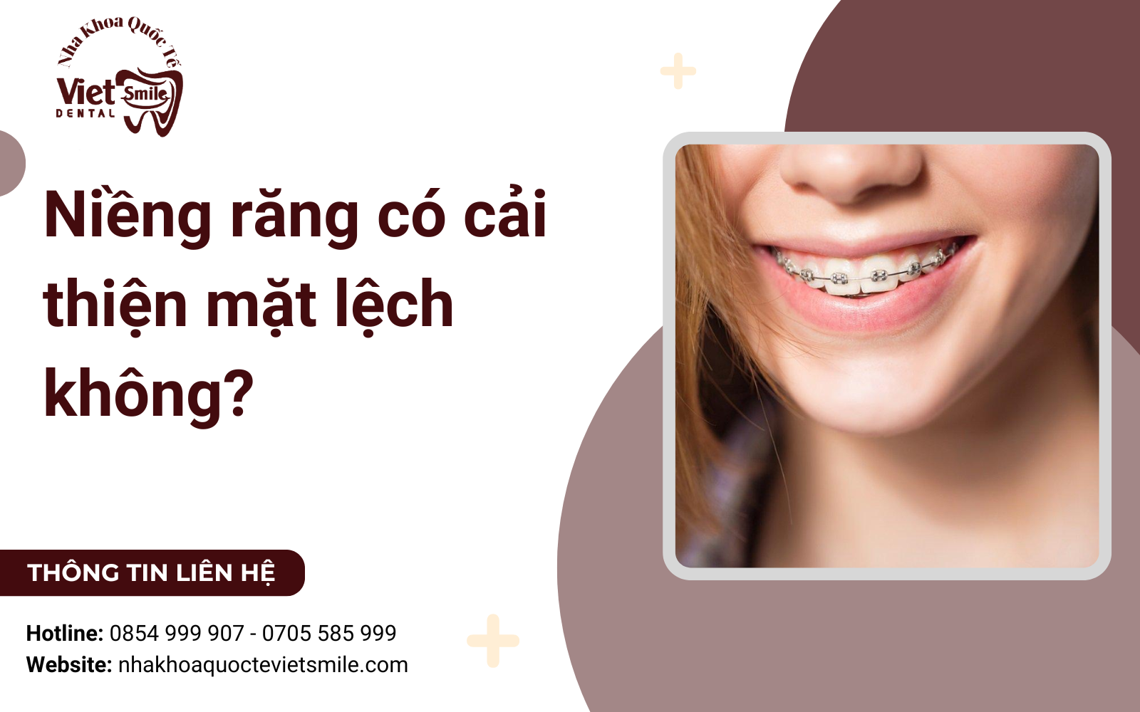 Niềng răng có cải thiện mặt lệch không?