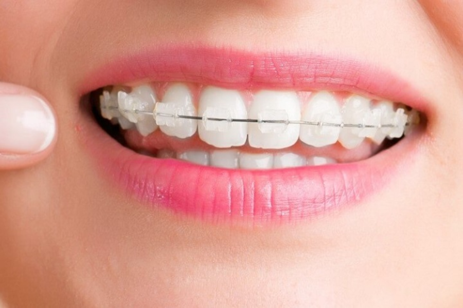 Niềng răng mắc cài sứ – Cân bằng giữa hiệu quả và thẩm mỹ khi niềng răng cải thiện mặt lệch