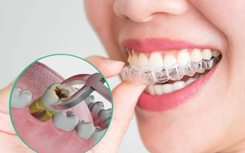 Niềng răng có phải nhổ răng không?