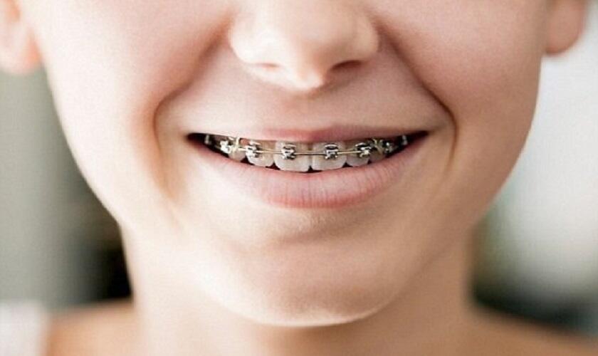 Niềng răng cho trẻ em