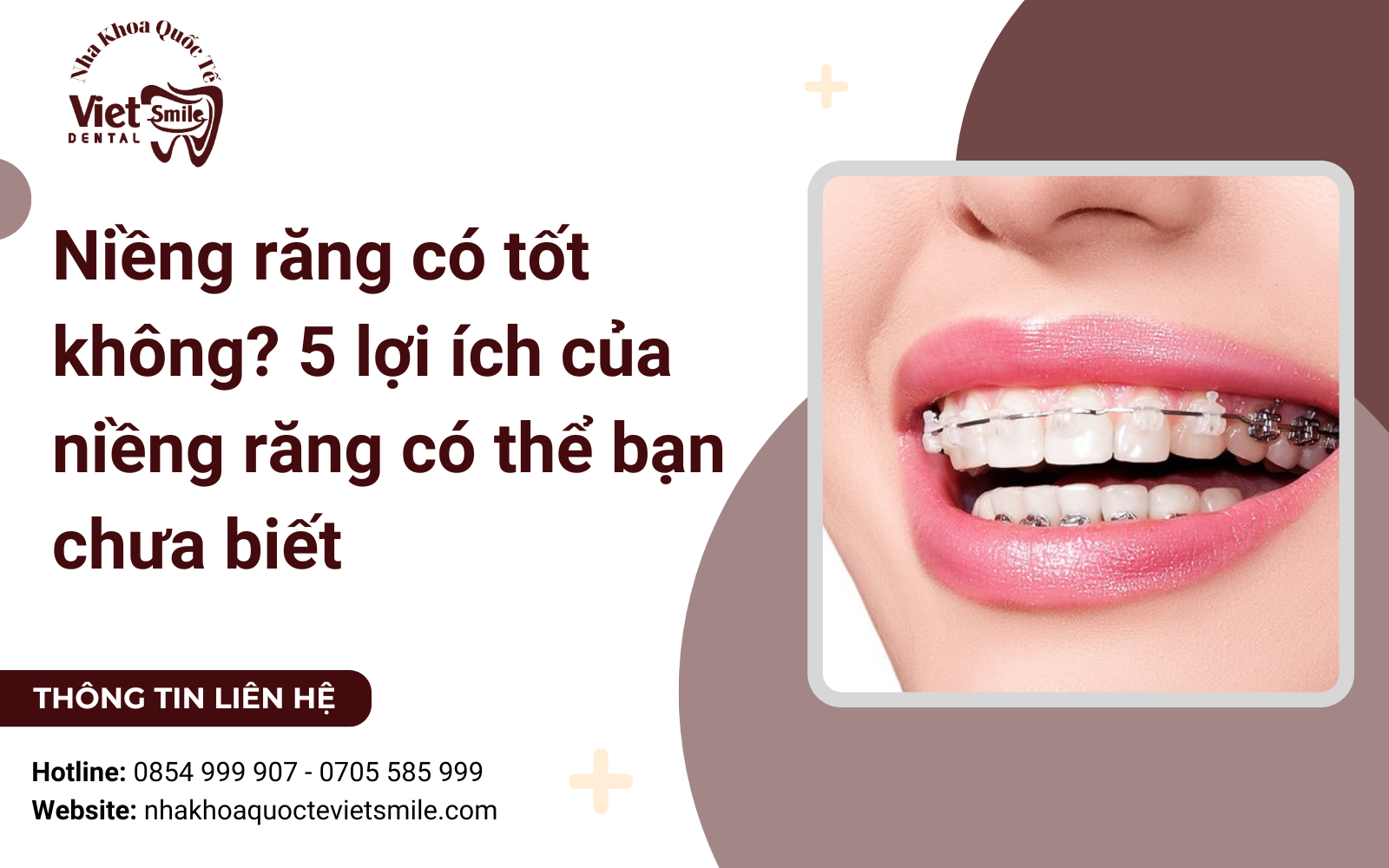 Niềng răng có tốt không? 5 lợi ích của niềng răng có thể bạn chưa biết