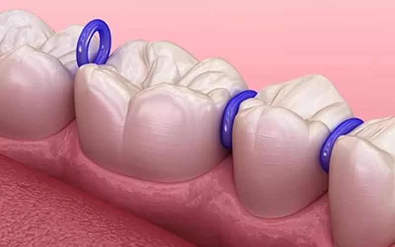 Giai đoạn đặt thun tách kẽ: Mở đường cho răng dịch chuyển