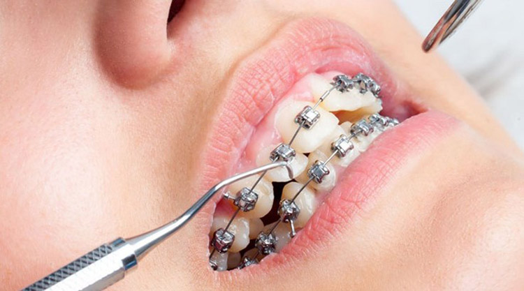 Giai đoạn tái khám và siết răng (rút dây cung, tăng lực kéo)