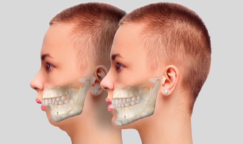 Răng hô hàm trên là gì?