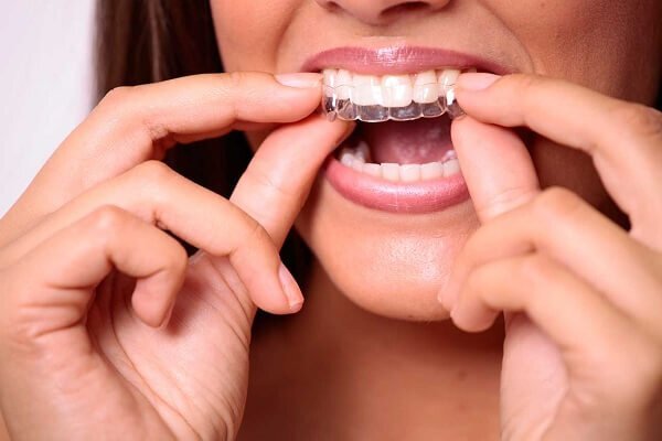 Thời gian niềng răng Invisalign mất bao lâu?