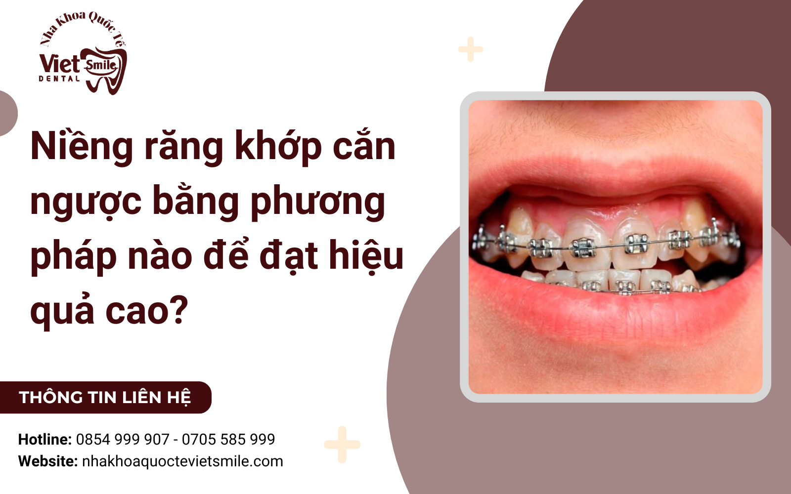 Niềng răng khớp cắn ngược bằng phương pháp nào để đạt hiệu quả cao?