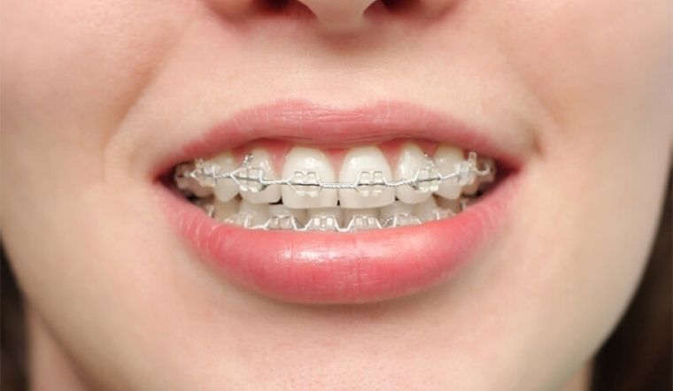 Niềng răng là gì? Đối tượng nào được chỉ định niềng răng?
