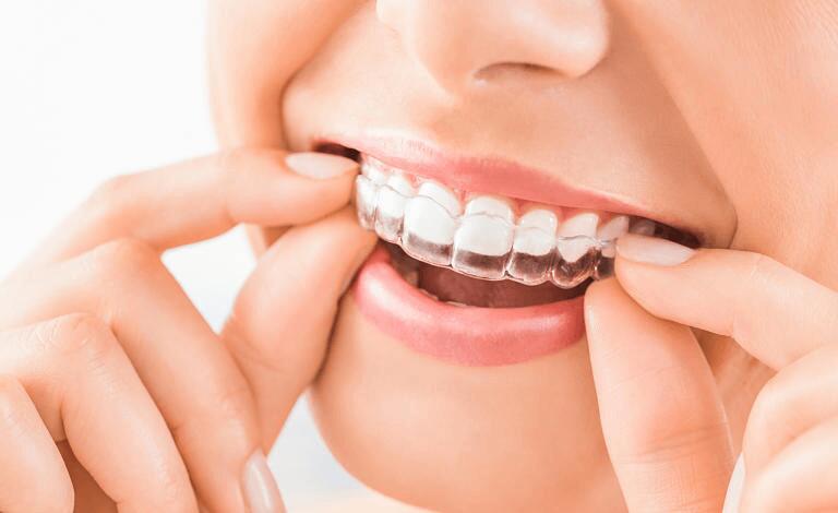 Niềng răng trong suốt Zenyum hoạt động như thế nào?