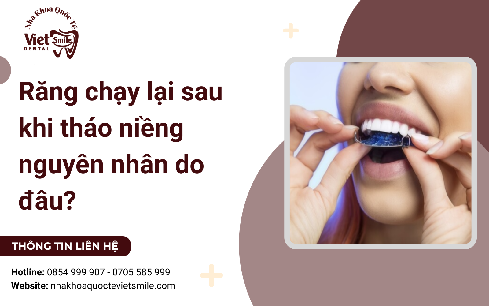 Răng chạy lại sau khi tháo niềng nguyên nhân do đâu?