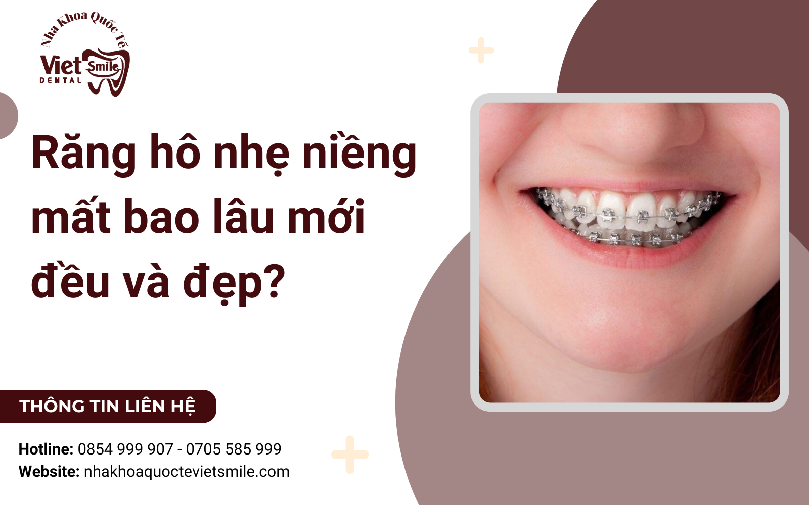 Niềng răng hô nhẹ mất bao lâu