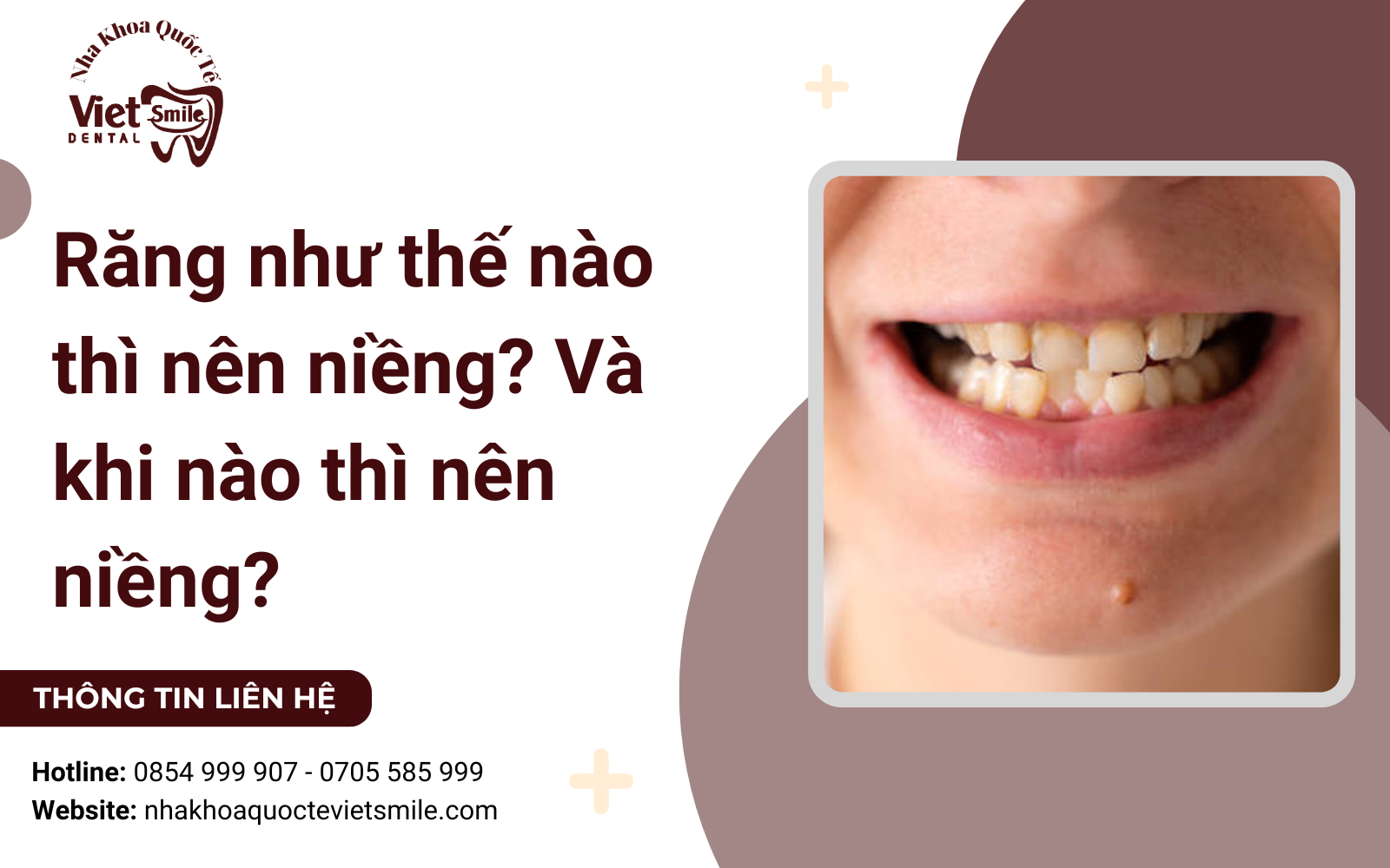 Răng như thế nào thì nên niềng?