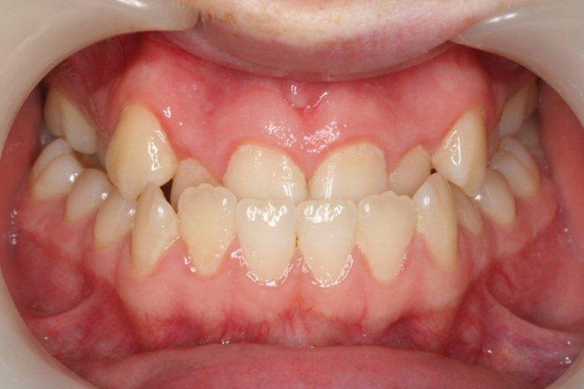 Răng móm (khớp cắn ngược) - Trường hợp răng như thế nào thì nên niềng cần can thiệp sớm