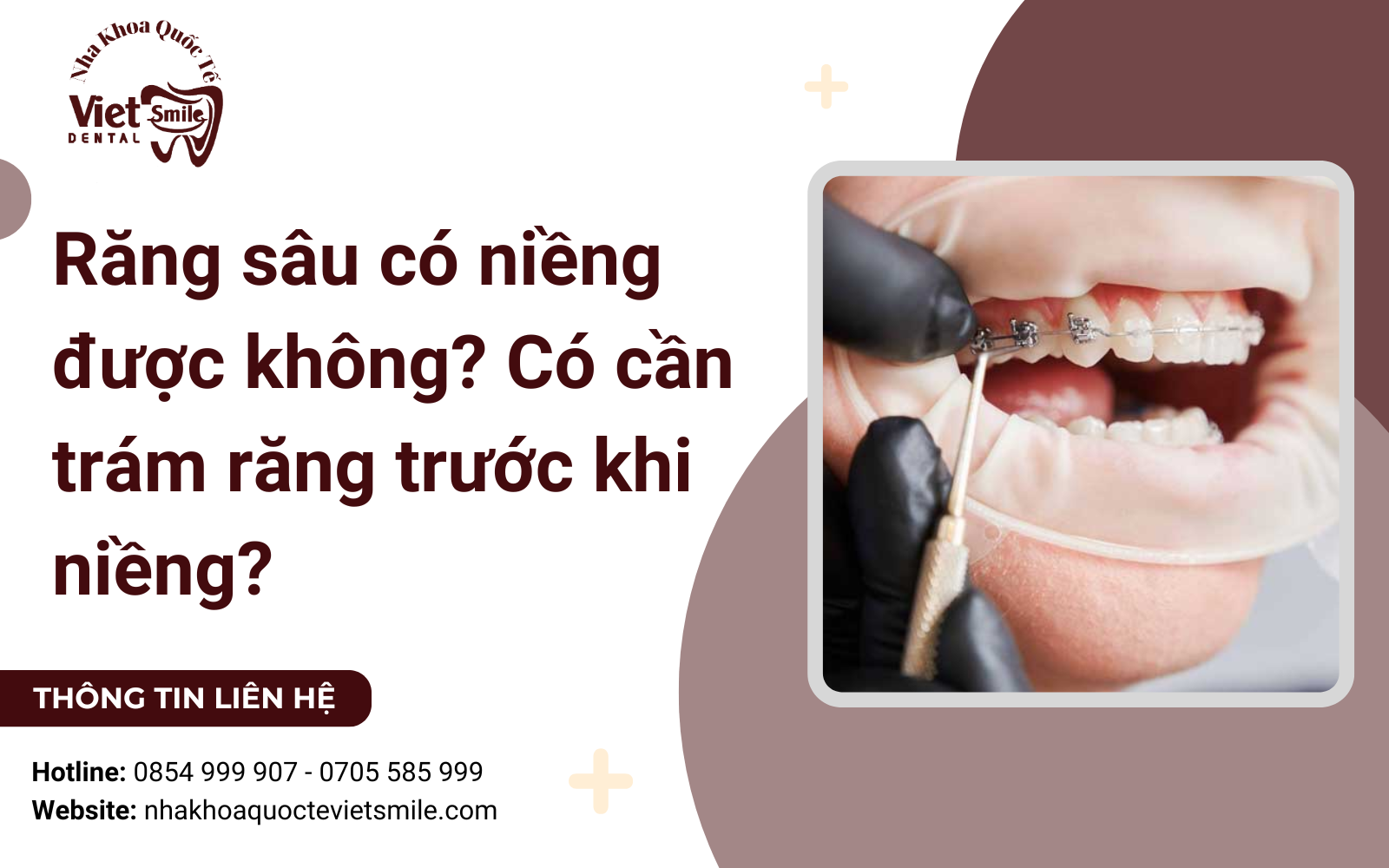 Răng sâu có niềng được không? Có cần trám răng trước khi niềng?