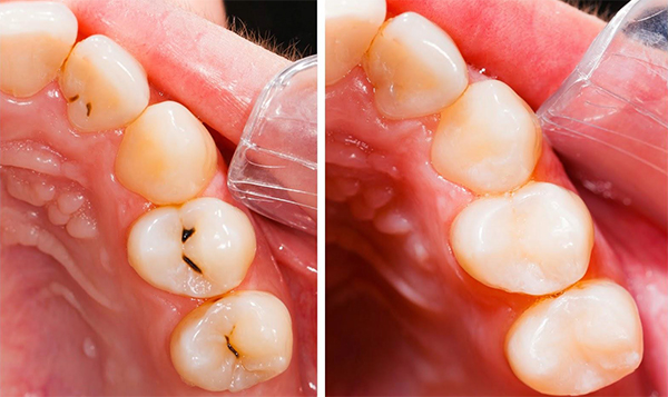 Trám răng rồi thì niềng răng có ảnh hưởng gì không?