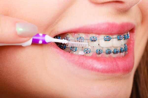 Làm sao để trong quá trình niềng răng không bị sâu răng?