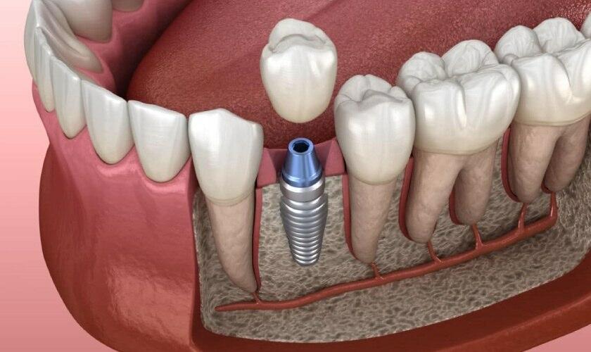 Bọc răng sứ Implant là gì?