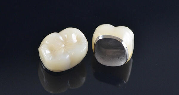 Bọc răng sứ Implant với răng sứ kim loại