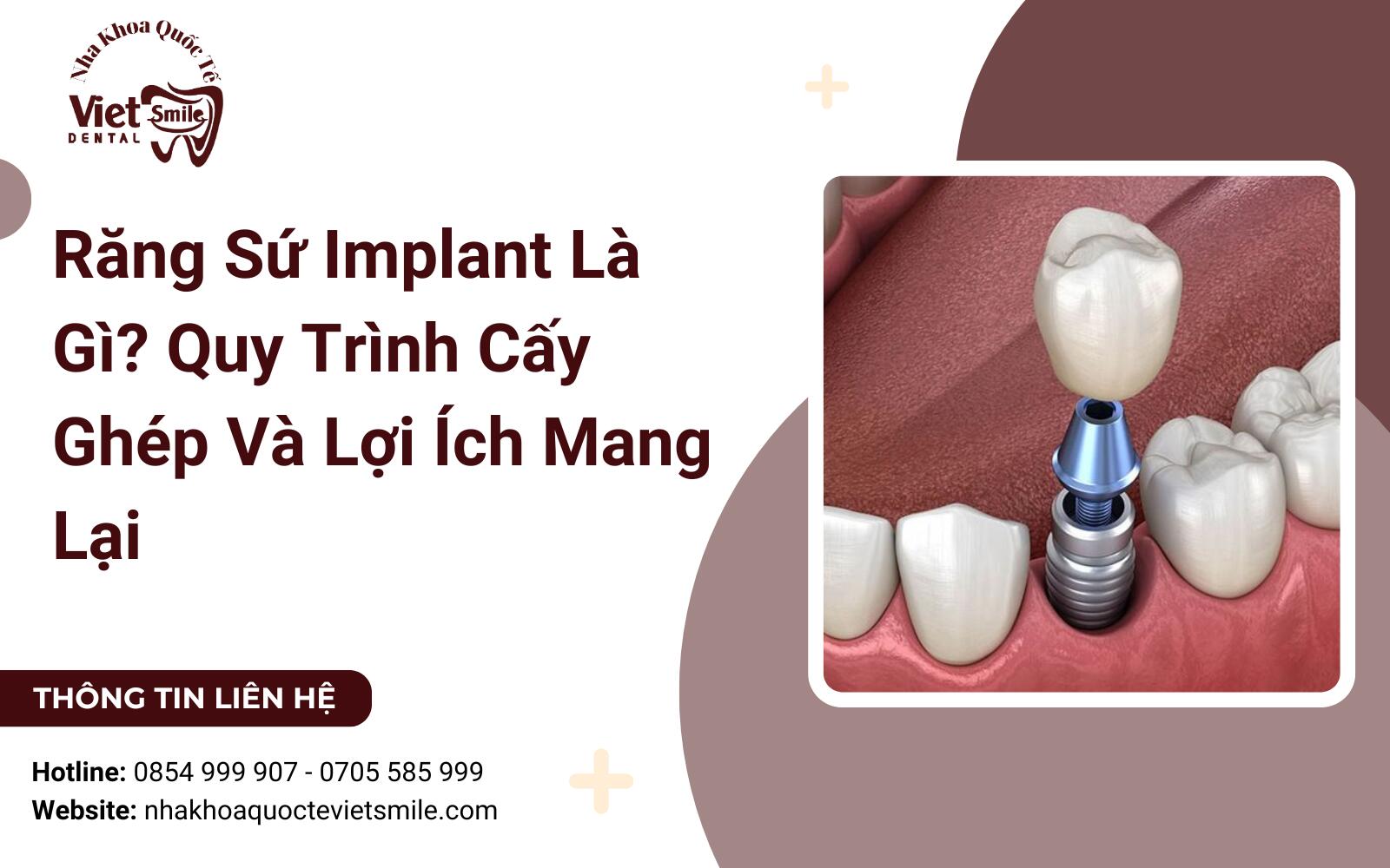 Cấy ghép răng sứ implant: Quy trình hiện đại, hiệu quả lâu dài. Hướng dẫn chi tiết về loại răng sứ, thời gian phục hồi và chăm sóc sau phẫu thuật.