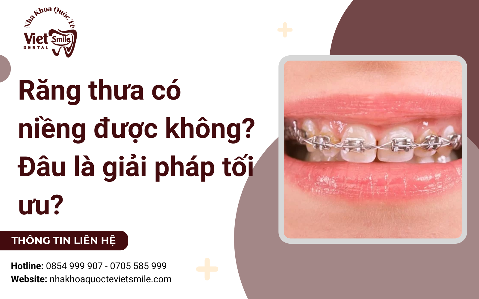 Răng thưa có niềng được không? Đâu là giải pháp tối ưu?