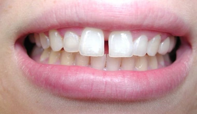 Răng thưa là gì?