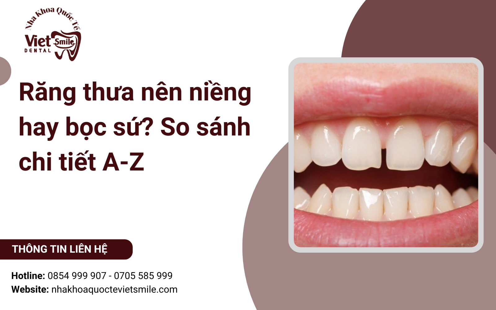 Răng thưa nên niềng hay bọc sứ? So sánh chi tiết A-Z