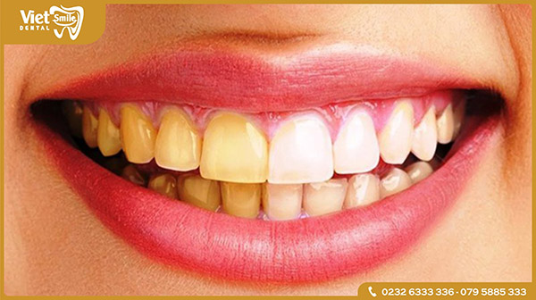 Khi nào bạn nên tẩy trắng răng?