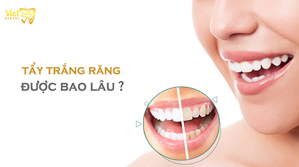 Tẩy trắng răng được bao lâu thì làm lại?