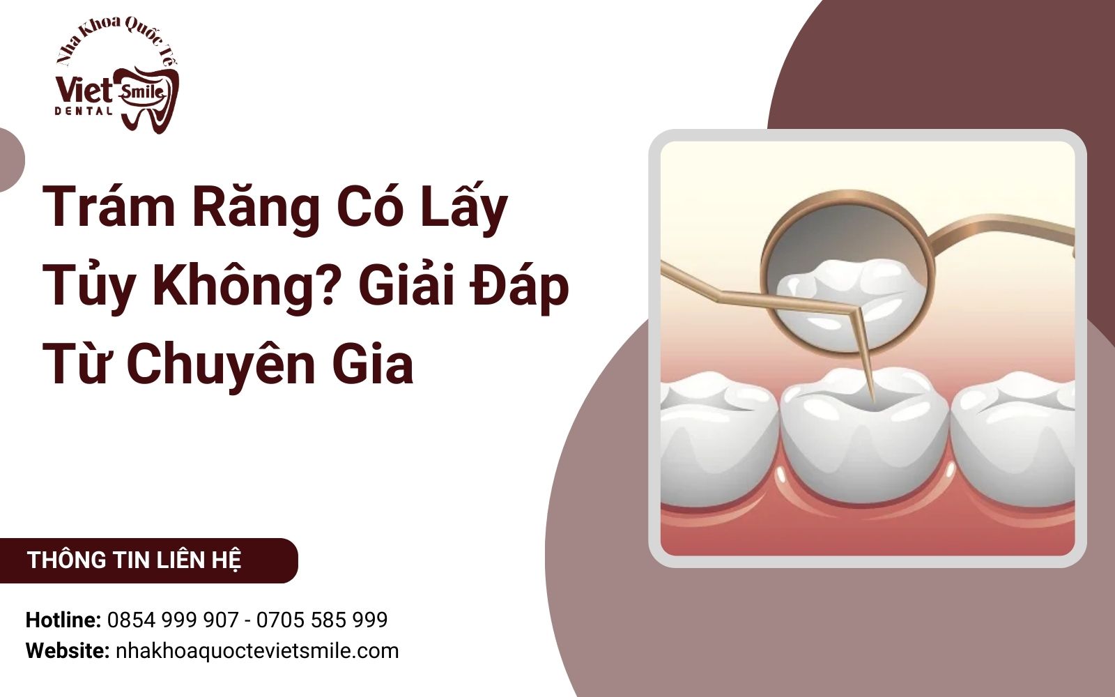 Trám Răng Có Lấy Tủy Không? Giải Đáp Từ Chuyên Gia