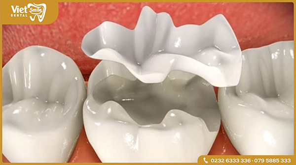 Trám răng Composite có bền không?