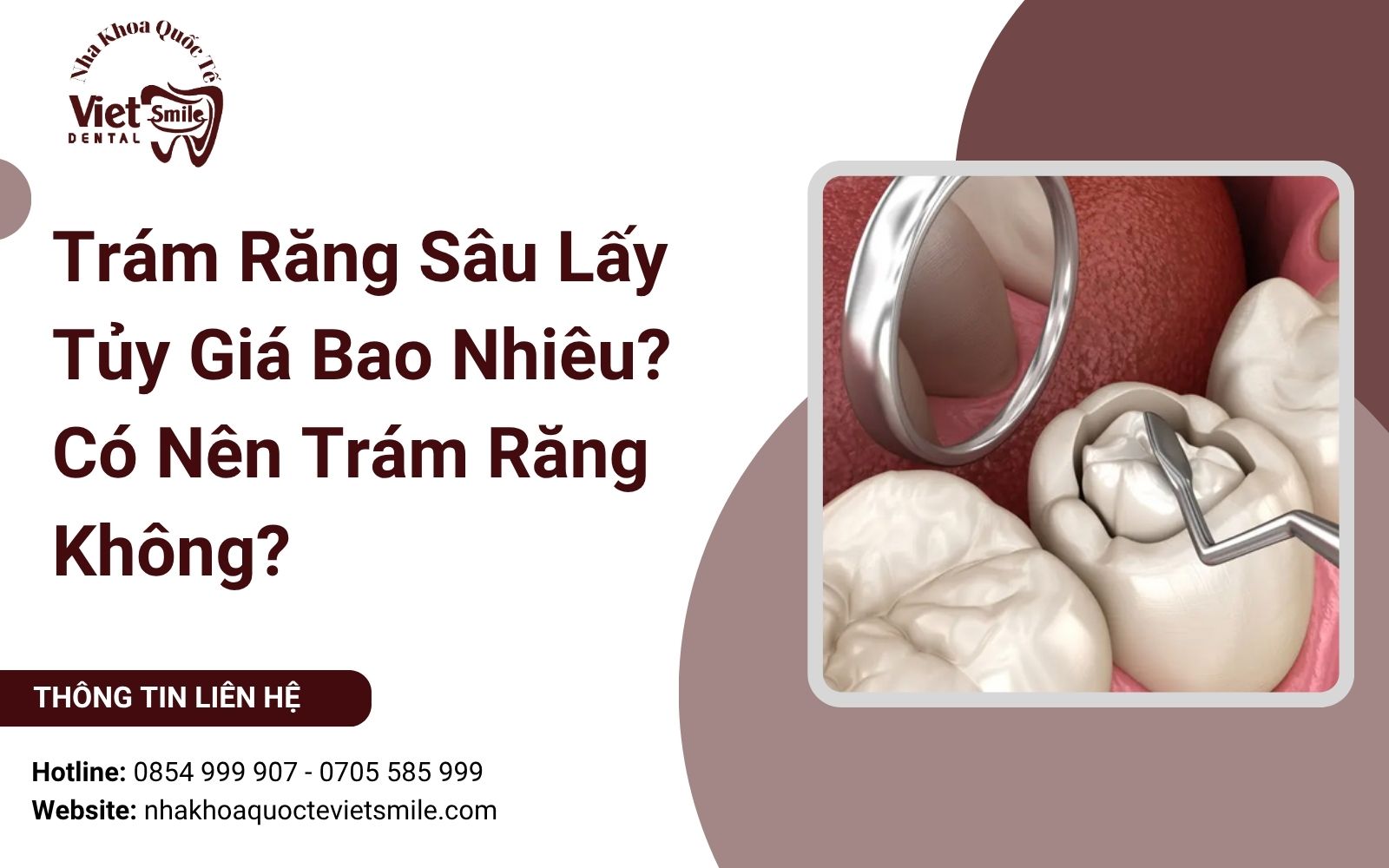 Trám Răng Sâu Lấy Tủy Giá Bao Nhiêu? Có Nên Trám Răng Không?