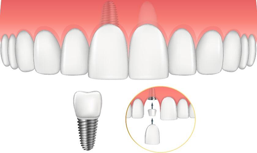 Răng cửa Implant có bền không?