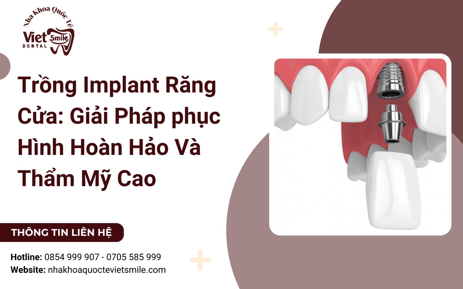 Trồng Implant Răng Cửa: Giải Pháp phục Hình Hoàn Hảo Và Thẩm Mỹ Cao